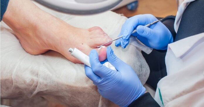 Hogyan vágjuk ki a benőtt körmöt?