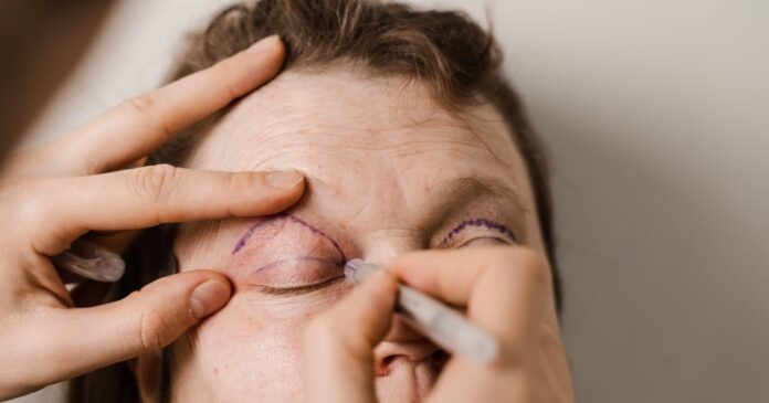 Páciens szemhéjkorrekció előtt