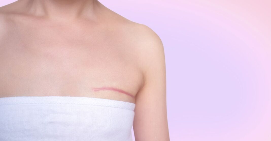 Breast cancer surgery scars by partial mastectomy. She can wear a tube top or tube dress and strapless with confident. With effect filter. melleltávolító műtét utáni heg