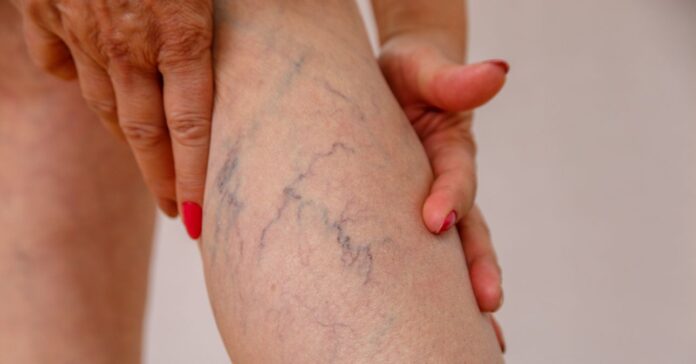 visszeres láb idősebb nőnél