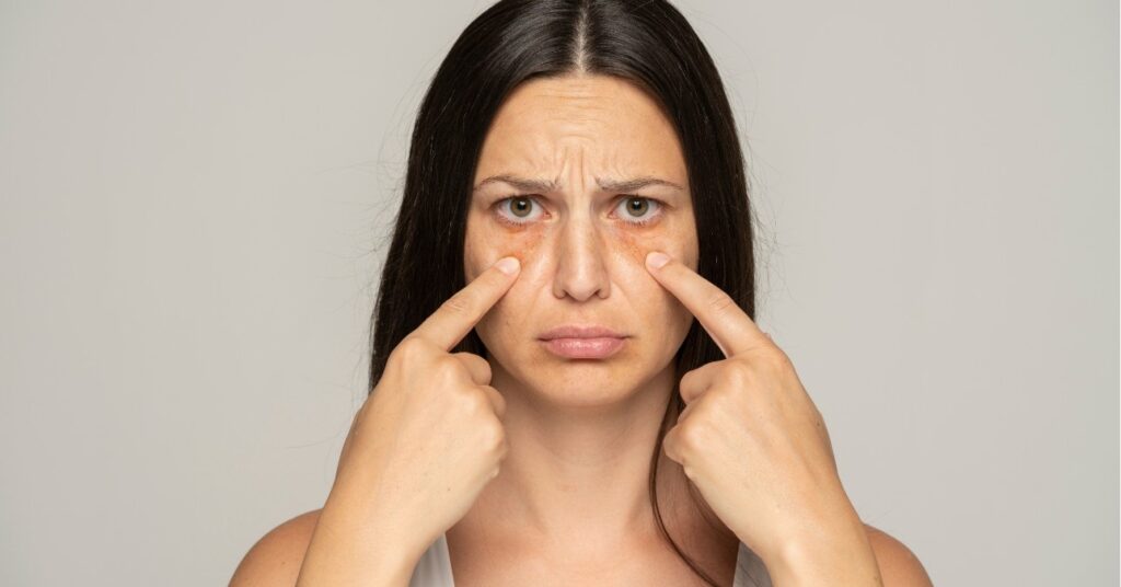 táskás szem ellen, szem alatti karika