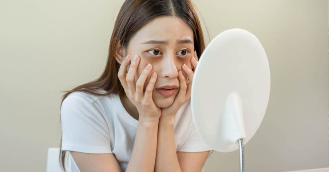 táskás szem ellen, szem alatti karika