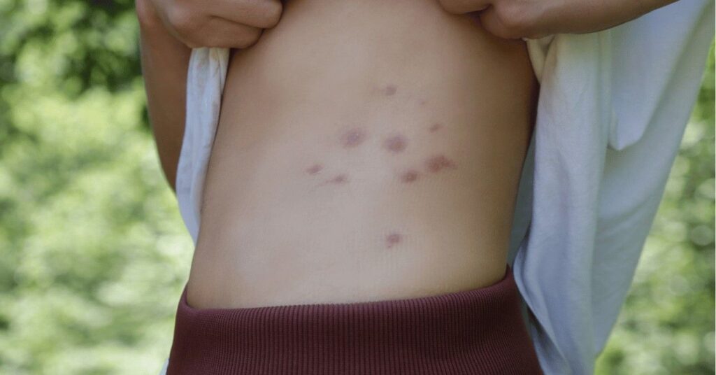 ágyi poloska csípés kezelése