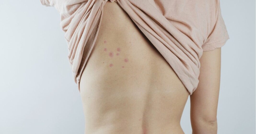 ágyi poloska csípés kezelése